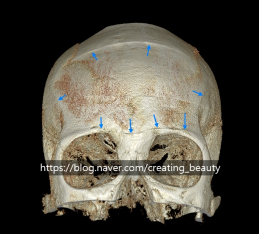 I Removed Two Forehead Implants. A Board-Certified Plastic Surgeon Explains Why I Do Not Recommend Forehead Implants. image 2