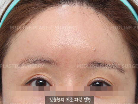 I want to go back to how it was before the forehead liftㅠ Is forehead lift reversal or release possible? image 3