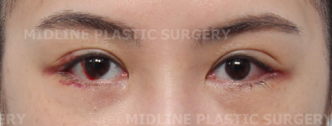 What Type of Plastic Surgery Is Needed for Small, Cramped Eyes? (About Lateral, Lower, and Combined Lateral-Lower Canthoplasty) image 23
