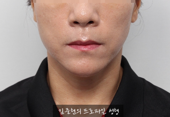 수술없이 간단하게 안면비대칭, 턱끝 비대칭(미드라인 맞추기) 해결하기!! 관련 이미지 7