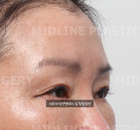 콧등 보톡스로 해결할 수 없는 콧등 가로주름!! 근본적인 해결에 대하여 알려드립니다. 관련 이미지 10