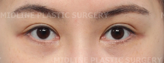 What Type of Plastic Surgery Is Needed for Small, Cramped Eyes? (About Lateral, Lower, and Combined Lateral-Lower Canthoplasty) image 21