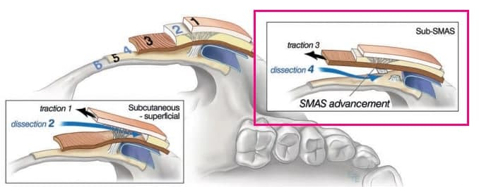 Fixing Sagging After Facial Contouring Surgery with a Face Lift!! (Feat. Plate Removal, Plate & Screw Removal) image 8