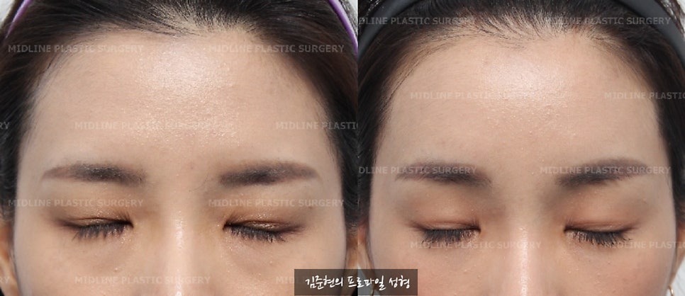 이마거상이 필요한 전형적인 케이스를 소개합니다! 더 일찍 할 껄ㅠㅠ하지 마시고 지금이 제일 빠를 때입니다. (Feat. 눈밑지방재배치와 눈밑지방이식) 관련 이미지 4