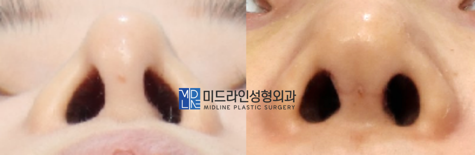 The Plastic Surgery Specialist Explains Septoplasty, One of the Methods for Functional Nose Surgery for Rhinitis. (feat. Swing-door Technique) image 8
