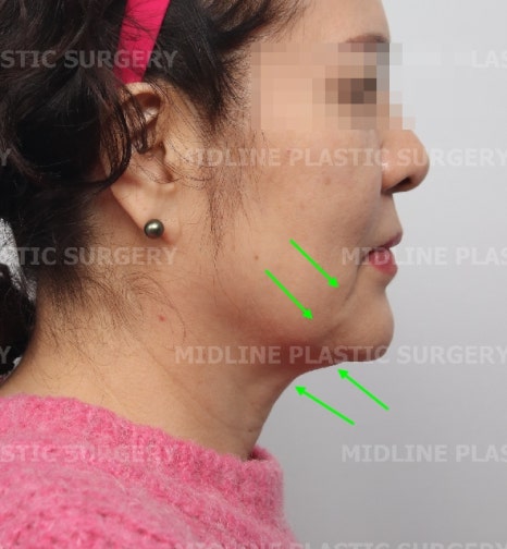 About Face Lifts That Are Effective for Improving Mouth Corners, Neck Wrinkles, and Cheek Sagging image 10