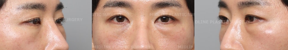 I Want to Get Rid of the Foreign Material Under My Eyes (Radiesse)ㅠ A Plastic Surgeon Explains Cases of Under-Eye Foreign Material Removal image 3