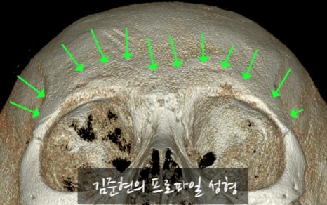 Let’s Learn About the Effects of Brow Bone Reduction Surgery. (Brow Bone? Eye Hole Bone? Here’s a Terminology Guide.) image 20