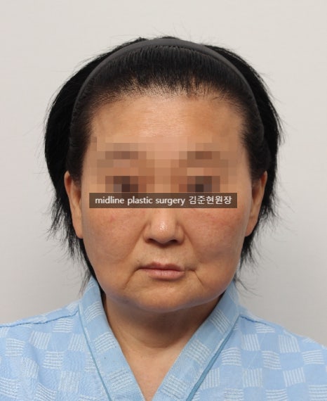 안면거상 흉터를 보여주는 곳은 없어서 미드라인성형외과가 보여드립니다. (feat. 심부볼리프팅) 관련 이미지 8