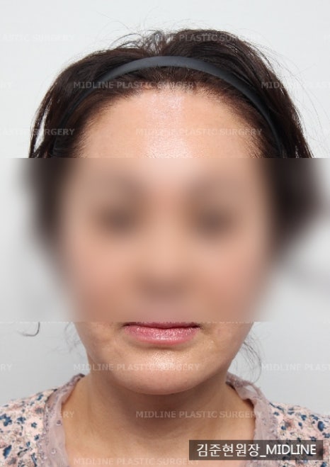 얼굴 주름 리프팅, 오래 지속되고 효과 좋은 수술방법은? 관련 이미지 9