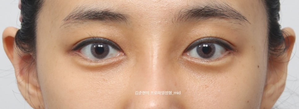 미드라인성형외과 김준현원장이 알려주는 눈밑지방재배치와 눈밑지방이식. 관련 이미지 2