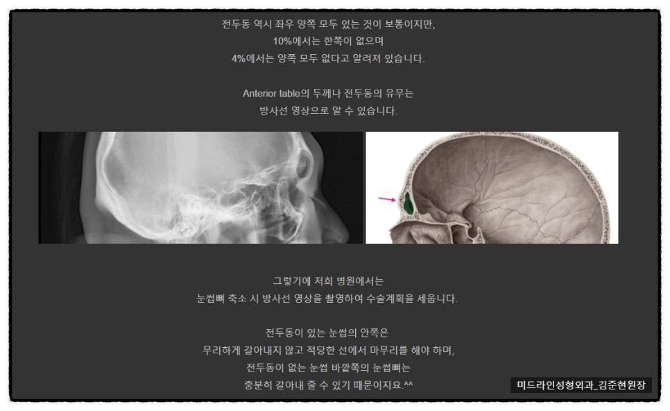 눈썹뼈 절삭에 관하여 (안와상융기) 관련 이미지 9