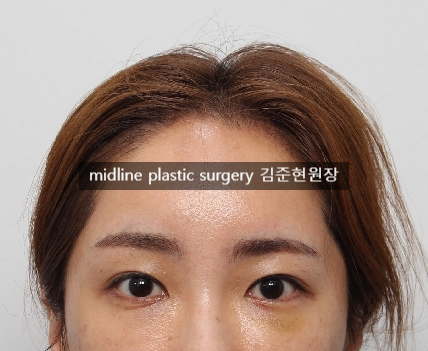 Forehead lift for people in their 20s and 30s: correcting eyelid sagging and even eye asymmetry! image 9