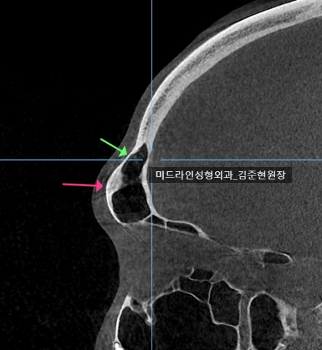 눈썹뼈 절삭에 관하여 (안와상융기) 관련 이미지 12