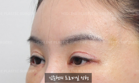 The outer corners of my eyes are open and my eyes stingㅠㅠI had lateral canthoplasty revision and eye corner restoration.(feat. Endoscopic forehead lift) image 6