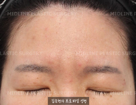 Because of the Mongolian fold, the eyes look cramped — epicanthoplasty can fix it. (Feat. Endoscopic forehead lift) image 8