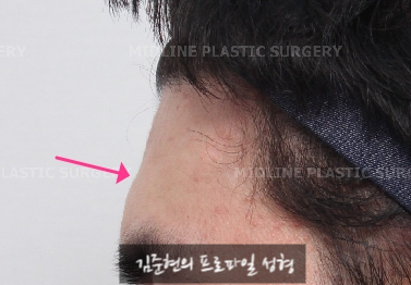 Let’s Learn About the Effects of Brow Bone Reduction Surgery. (Brow Bone? Eye Hole Bone? Here’s a Terminology Guide.) image 23