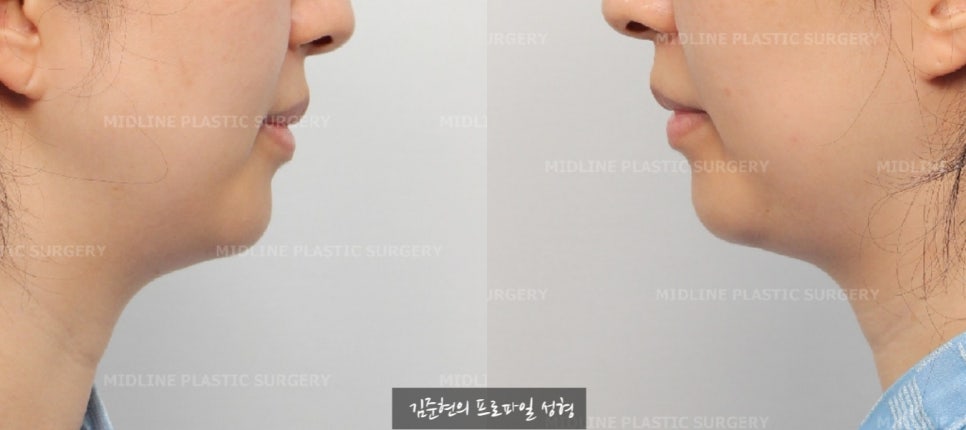 이중턱이 고민이에요ㅠㅠ숨은 턱선을 찾아주는 이중턱, 턱라인 지방흡입! 미드업 2040에 관하여 설명드립니다. 관련 이미지 7