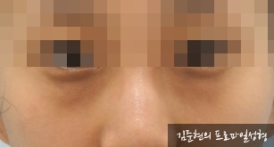 성형외과 전문의가 눈밑수술 케이스의 진단방법 및 나이들면 하는 수술이다라는 오해에 대해 설명해드립니다. 관련 이미지 3