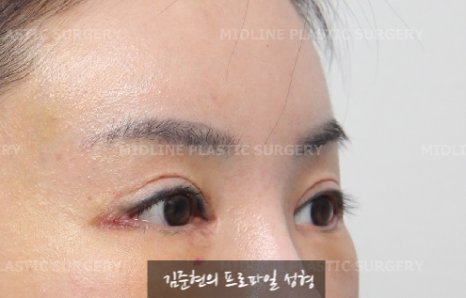 The outer corners of my eyes are open and my eyes stingㅠㅠI had lateral canthoplasty revision and eye corner restoration.(feat. Endoscopic forehead lift) image 4
