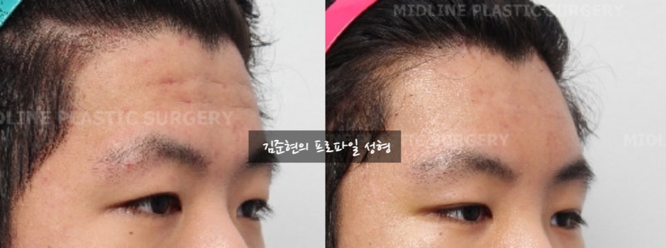 How Can Deep Forehead Wrinkles Be Resolved? (Feat. Forehead Lift + Filler) image 12