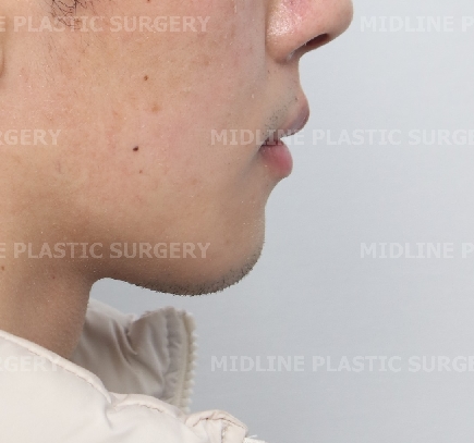 On the Effects of Advancement Genioplasty, Explained by a Board-Certified Plastic Surgeon. (feat. Rhinoplasty, Double Chin, Jawline Liposuction) image 6