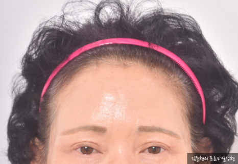 내시경 이마거상(Endoscopic forehead lift)에 대하여 성형외과 전문의가 알려드립니다. 관련 이미지 9