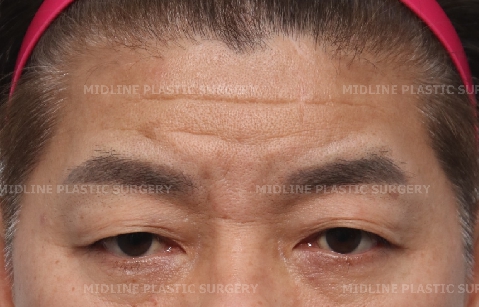 이마 주름이 너무 깊어졌어요ㅠㅠ.내시경 이마거상과 이마 주름 필러(Filler)로 어떻게 좋아지는지 성형외과 전문의가 설명드립니다. 관련 이미지 1