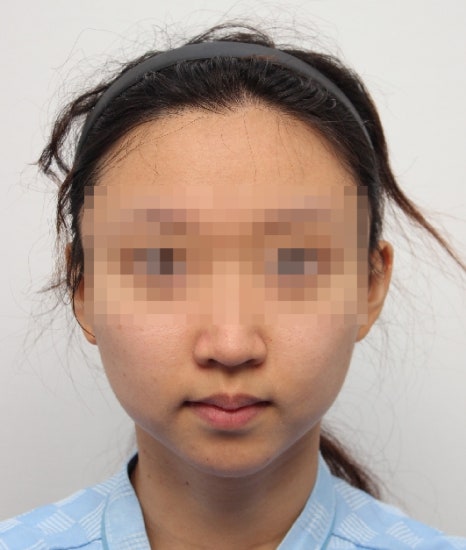 무턱 교정하면서 턱끝 비대칭(안면비대칭)까지 바로잡기! 관련 이미지 2