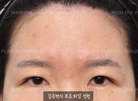 Because of the Mongolian fold, the eyes look cramped — epicanthoplasty can fix it. (Feat. Endoscopic forehead lift) image 2