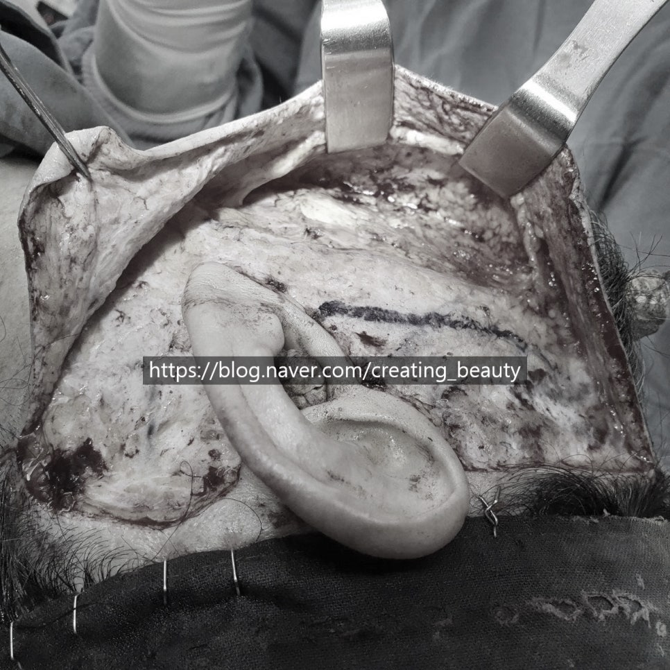 안면거상(Face lift, Rhytidectomy)에 대하여 성형외과 전문의가 알려드립니다. 관련 이미지 8