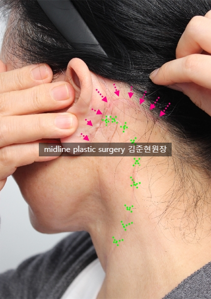 안면거상 흉터를 보여주는 곳은 없어서 미드라인성형외과가 보여드립니다. (feat. 심부볼리프팅) 관련 이미지 21