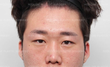 <3편> 큰 눈 만들기 프로젝트. 이마거상으로 커진 눈!! 쌍꺼풀 수술로 더 크게 만들기. 관련 이미지 8