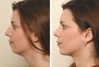 On the Effects of Advancement Genioplasty, Explained by a Board-Certified Plastic Surgeon. (feat. Rhinoplasty, Double Chin, Jawline Liposuction) image 4