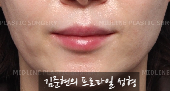 입술에 볼륨을 주는 방법은? 입술 지방이식에 관하여 관련 이미지 5