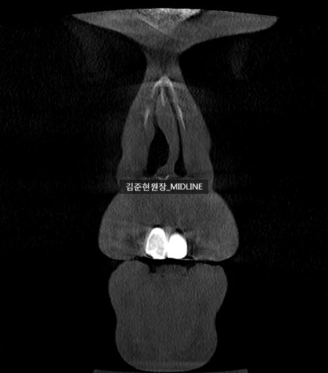 휜 코, 매부리 교정과 기능코-비중격만곡증까지 바로잡기 관련 이미지 34