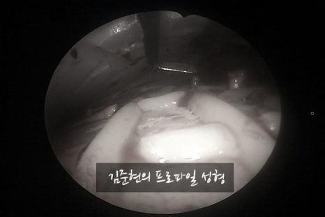 I Removed Two Forehead Implants. A Board-Certified Plastic Surgeon Explains Why I Do Not Recommend Forehead Implants. image 13