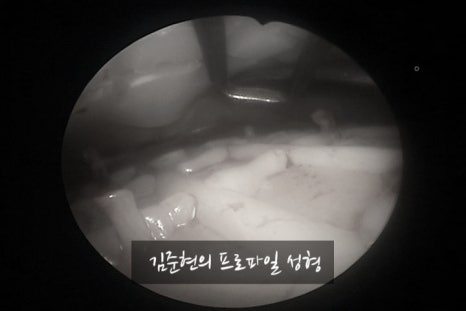 I Removed Two Forehead Implants. A Board-Certified Plastic Surgeon Explains Why I Do Not Recommend Forehead Implants. image 14
