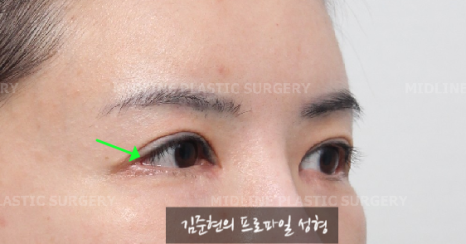 The outer corners of my eyes are open and my eyes stingㅠㅠI had lateral canthoplasty revision and eye corner restoration.(feat. Endoscopic forehead lift) image 2