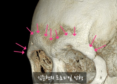 Let’s Learn About the Effects of Brow Bone Reduction Surgery. (Brow Bone? Eye Hole Bone? Here’s a Terminology Guide.) image 27