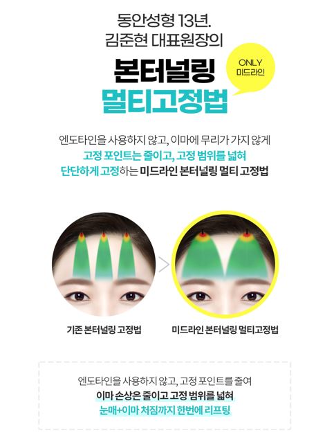 멀티 내시경이마거상술 vs 일반 이마거상술 차이점! 관련 이미지 5