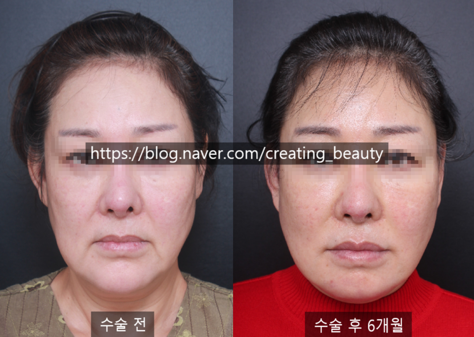 안면거상(Face lift, Rhytidectomy)에 대하여 성형외과 전문의가 알려드립니다. 관련 이미지 10