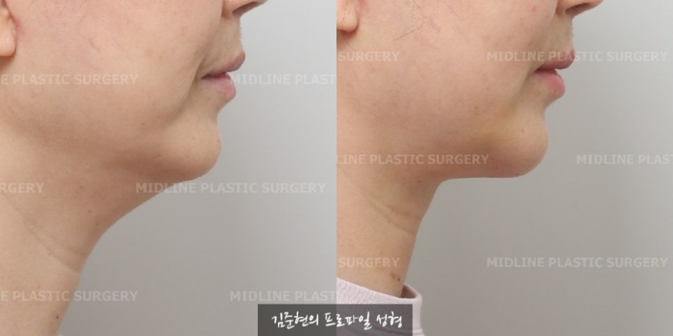 이중턱 근육 묶길 잘했어요^-^ 이중턱 근육묶기와 근육 밑 지방(포도송이 지방)제거까지 성형외과 전문의가 설명드립니다. 관련 이미지 8