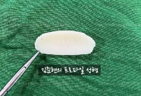 앞턱 보형물이 턱 옆으로 뚫고 나와요ㅠㅠ앞턱 보형물 제거 후 턱끝전진술을 한 케이스를 성형외과 전문의가 설명합니다. 관련 이미지 10