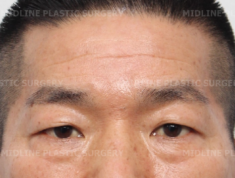 When Should Endoscopic Forehead Lift and Brow Lift Be Performed at the Same Time? (Feat. Lower Blepharoplasty) image 6