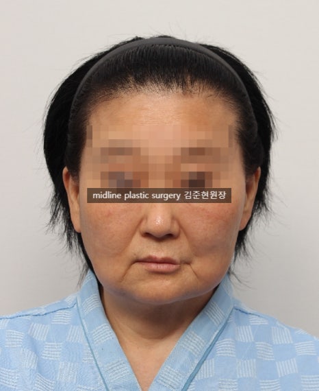 안면거상 흉터를 보여주는 곳은 없어서 미드라인성형외과가 보여드립니다. (feat. 심부볼리프팅) 관련 이미지 4