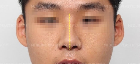 휜 코, 매부리 교정과 기능코-비중격만곡증까지 바로잡기 관련 이미지 23