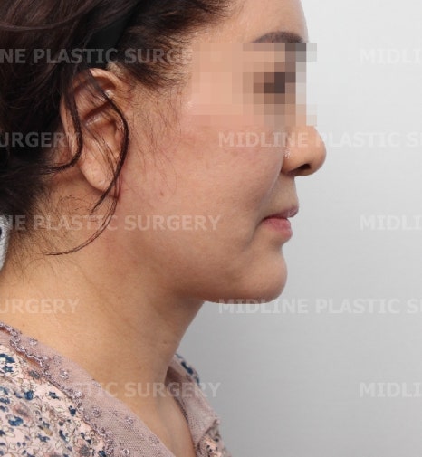 About Face Lifts That Are Effective for Improving Mouth Corners, Neck Wrinkles, and Cheek Sagging image 11