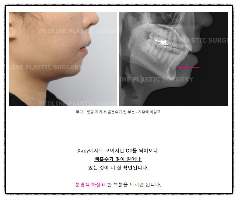 윤곽 후 핀제거 수술 케이스, 꼭 필요한 것인가? 관련 이미지 1