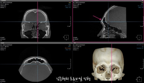 눈썹뼈절삭, 어떨 때 어떻게 하는 수술일까요? 꼭 이마거상과 함께 해야만 하는 수술인가요? 미드라인성형외과에서 하는 눈썹뼈절삭 수술을 설명드립니다. (3D CT 있음) 관련 이미지 20